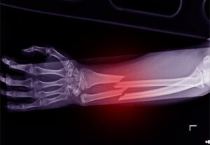 An x-ray shows a fractured forearm. 