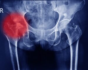 A x-ray shows a hip injury.