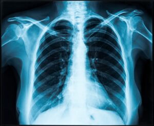 A full chest x-ray