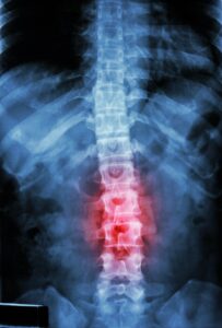 SPINAL X-RAY SHOWING SORE AREA