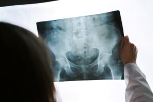 A doctor looking at an X-ray of a patient's pelvis.